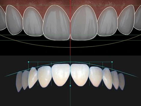 Smile Design Package