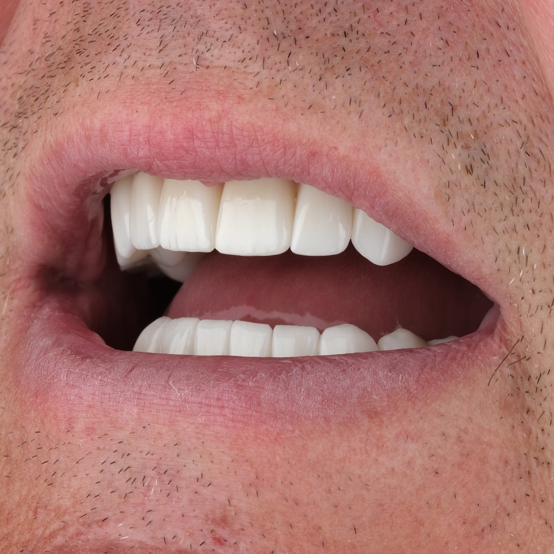 all on four implants after