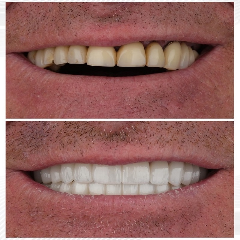 all on 4 implants before after