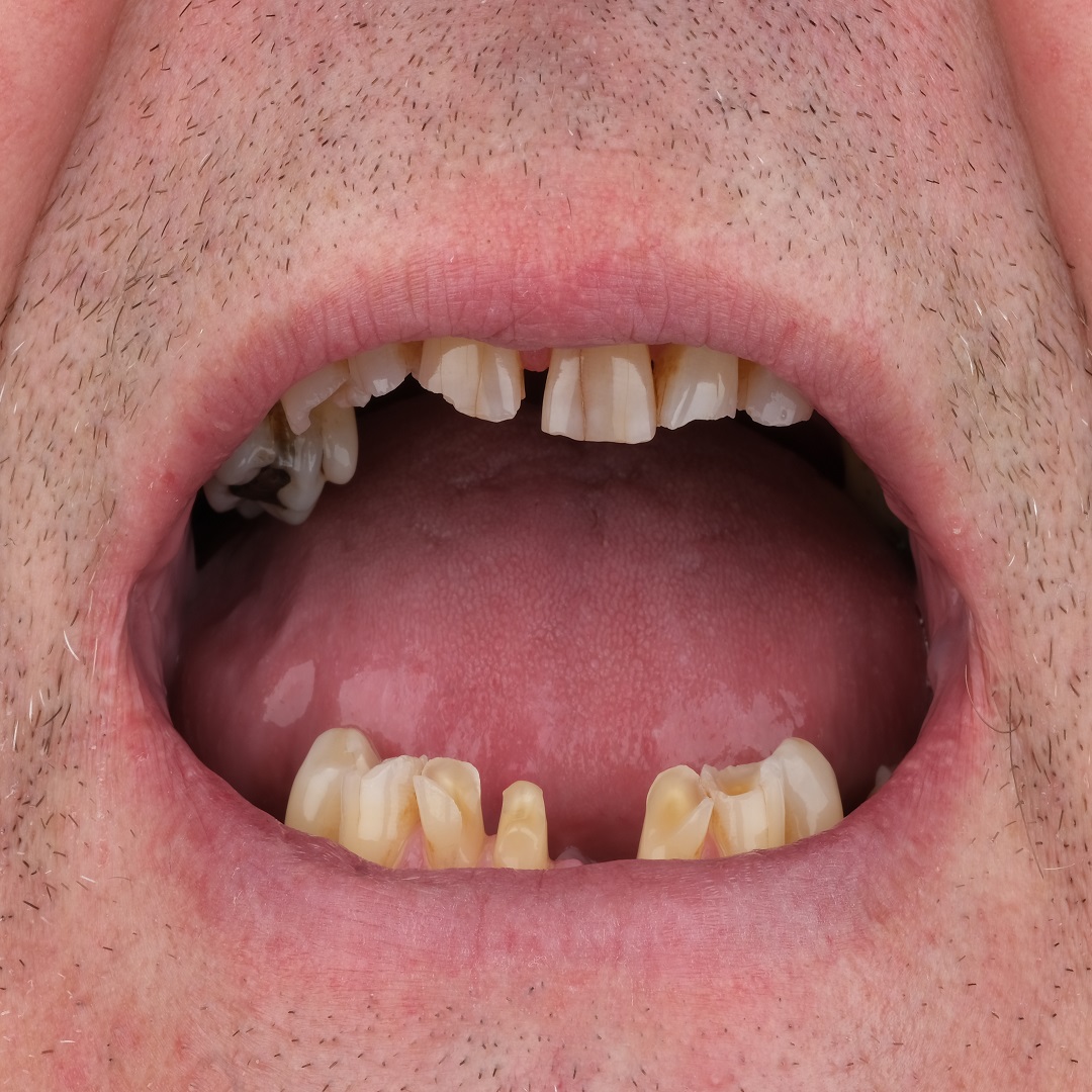 all on four dental implants turkey before