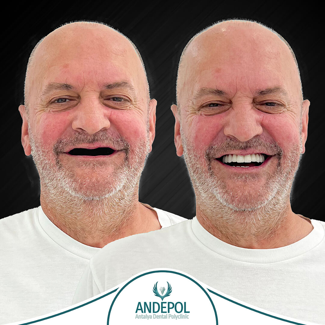 dental implant packages before after