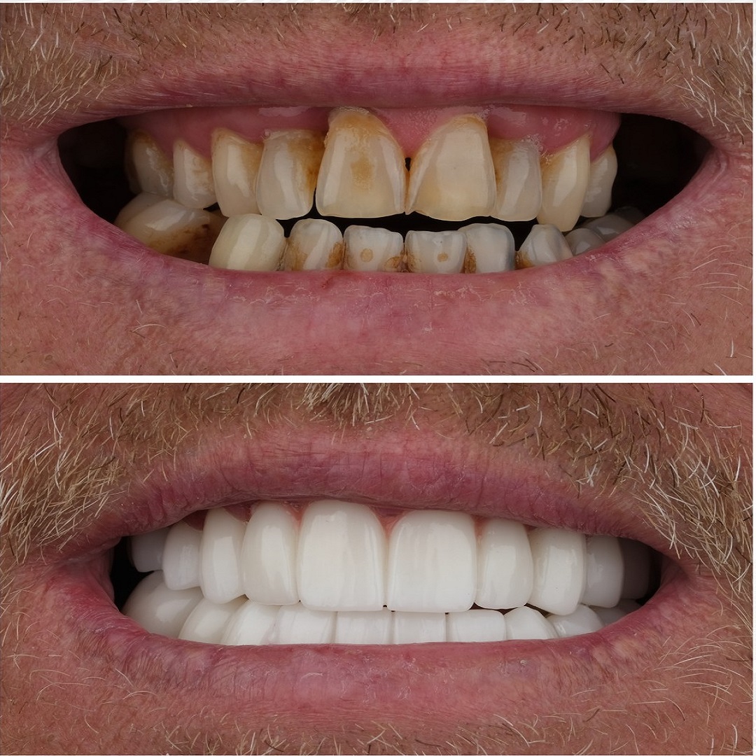 David before and after Dental implants and crowns installed in Turkey