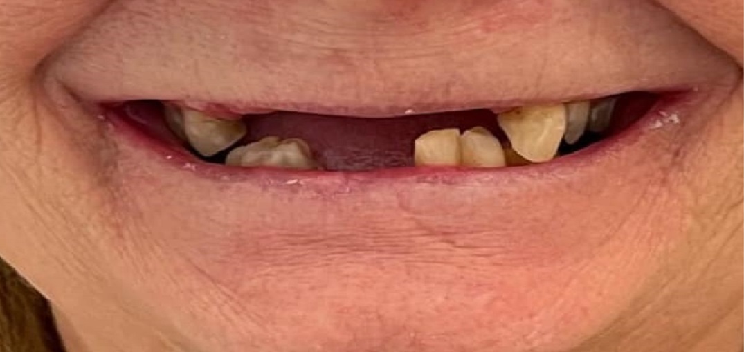 dentures before