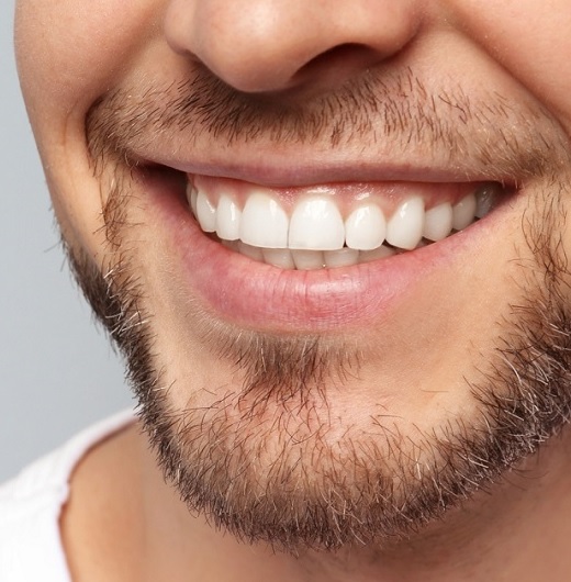 Smile design andepol antalya turkey patient