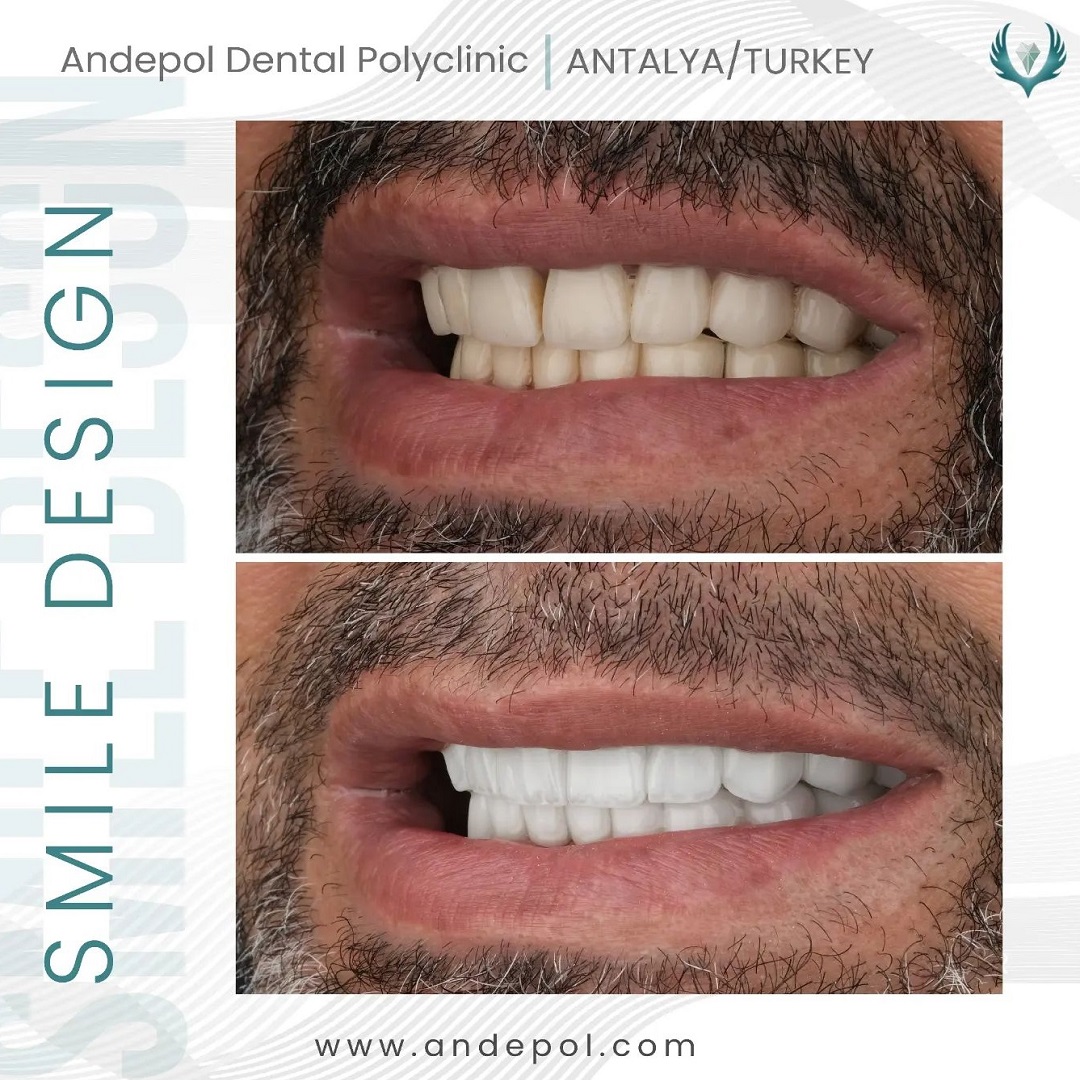 teeth whitening before after