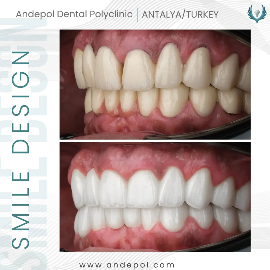 laser teeth whitening before after