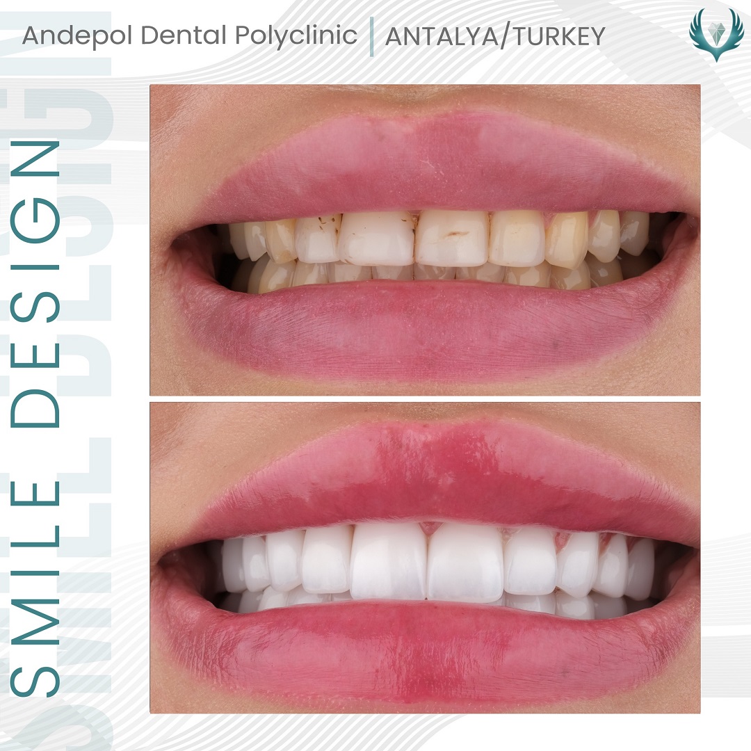 teeth whitening turkey before after