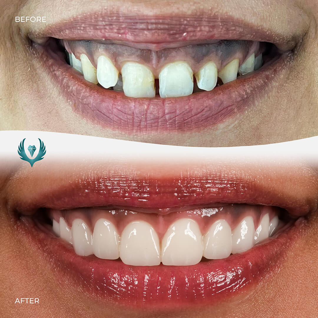 zirconia crown turkey before after