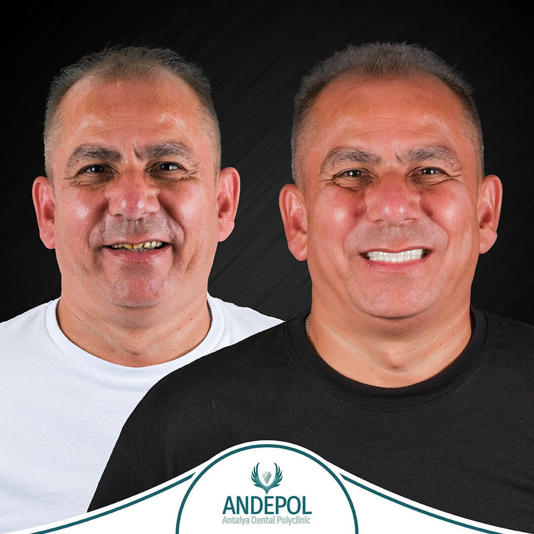 zirconia crowns turkey before
