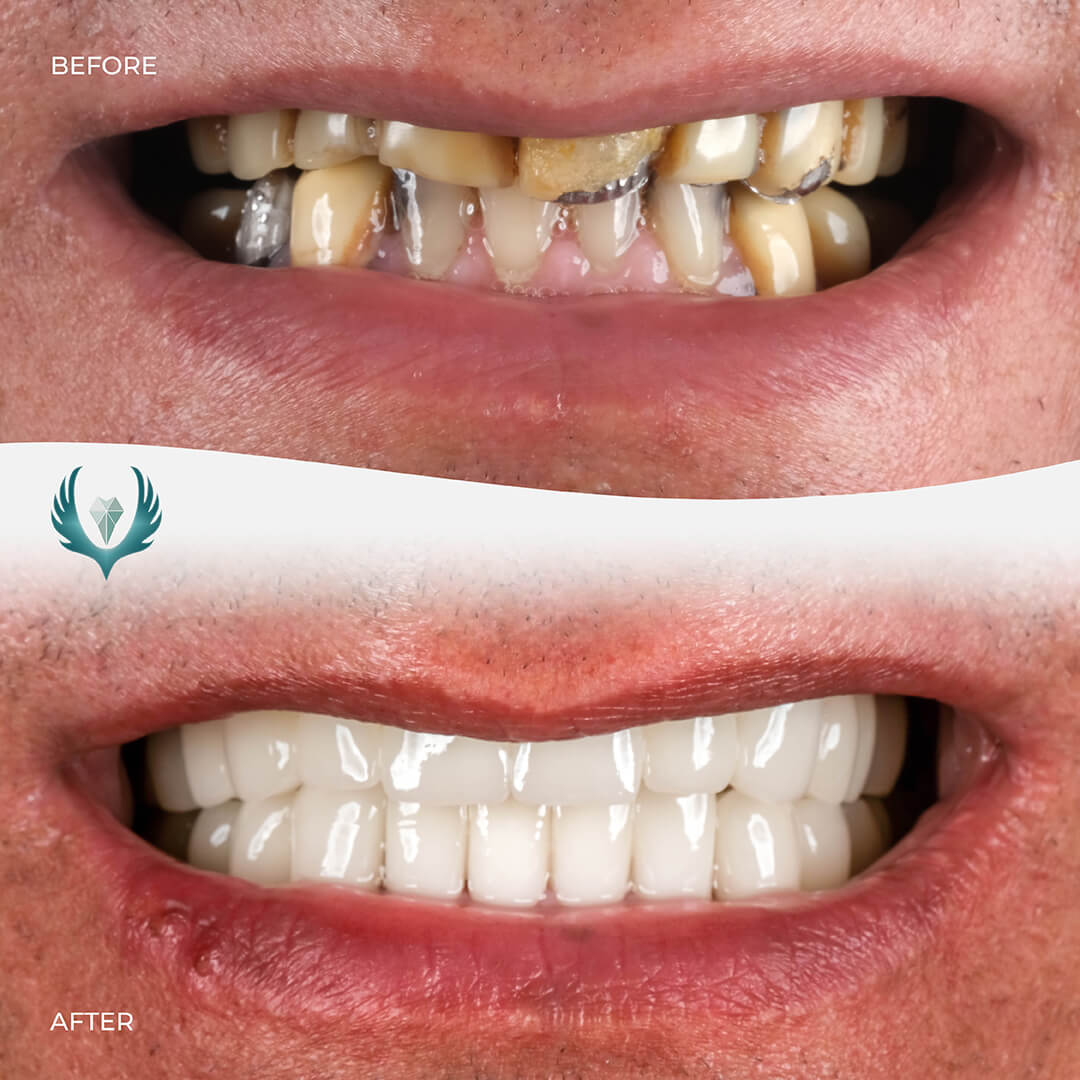 zirconia crown before after