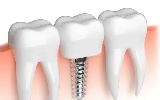 implant diş