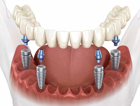 All on 4 Dental implants Turkey