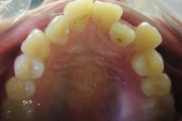 lingual braces before