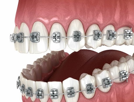 Dental Braces