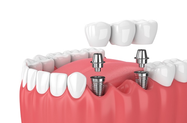 dental bridges