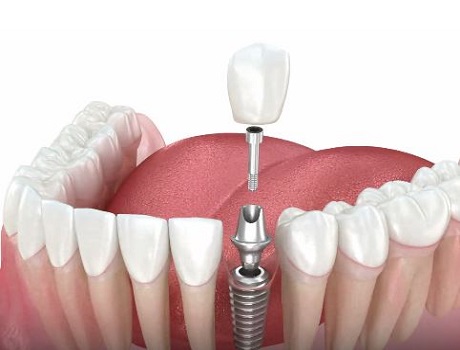 dental implants turkey