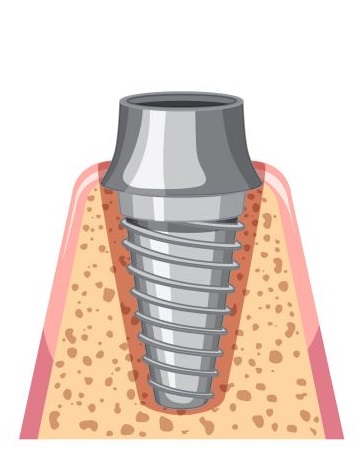 implant abutment stage