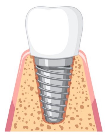implant crowns placement