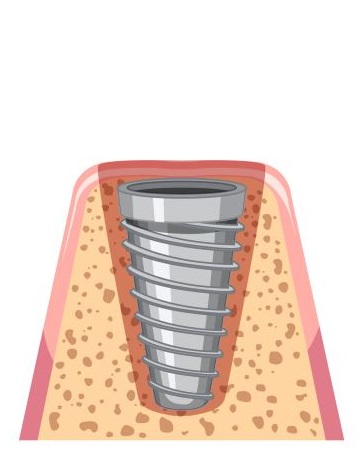implant fixture stage