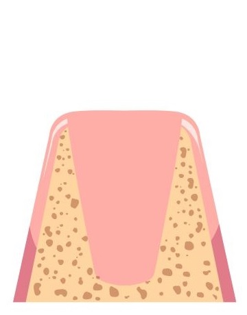 implant surgery stage
