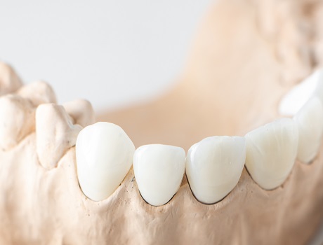 Laminate Veneers