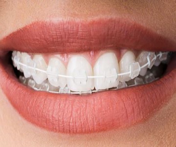 ceramic braces
