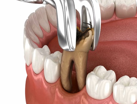 Tooth Extraction