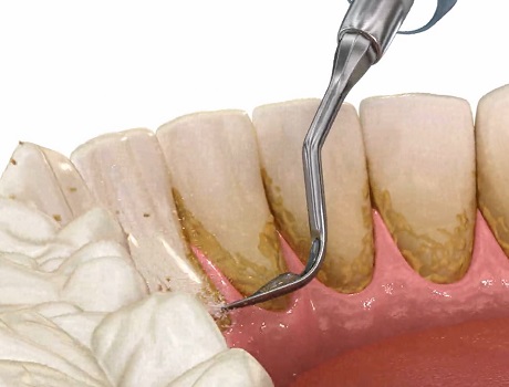 Tooth Stone Cleaning