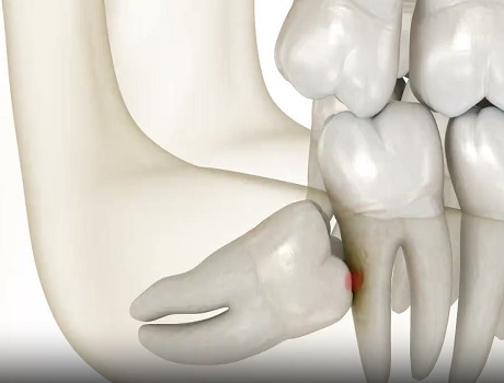 Wisdom Teeth Removal Turkey