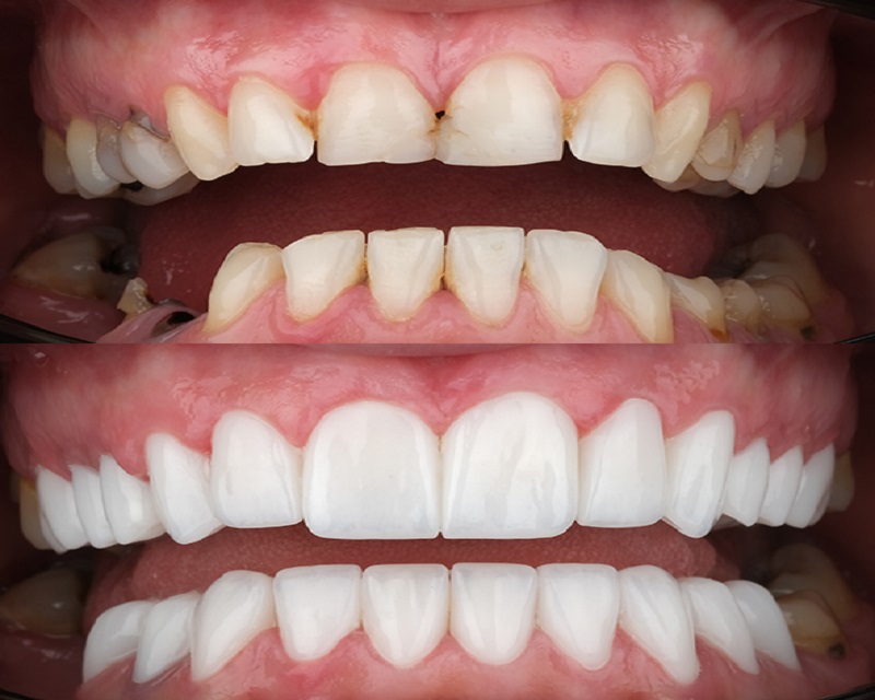 Zirconia Crown Turkey