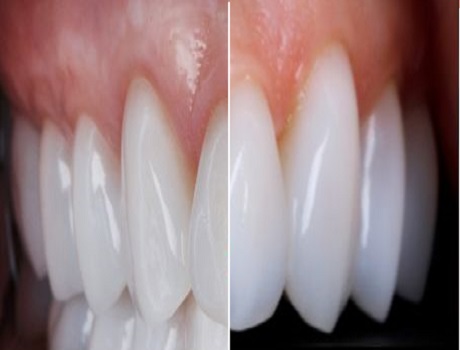 zirconia vs porcelain